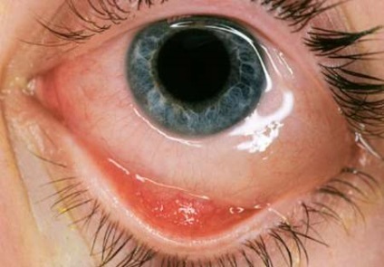 Gennyes kötőhártya-gyulladás, a szem kezelések felnőtt, okai