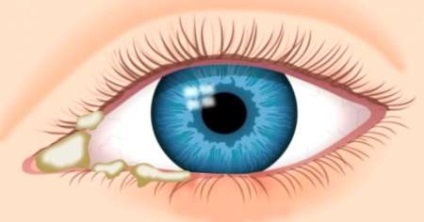 Gennyes kötőhártya-gyulladás, a szem kezelések felnőtt, okai