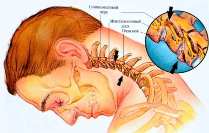 Porckorongsérv nyaki gerinc tünetek, kezelés, torna
