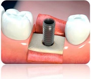 Implantátumok - Fogászati - Fogbeültetés Moszkvában! (Protézielemével) Implantátumok - Fogászati - Fogbeültetés Moszkvában!