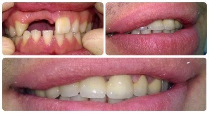 A fogászati implantátumok beteg beszámolók, olvasás, fotó, video (beteg) A fogászati implantátumok beteg beszámolók, olvasás, fotó, videó