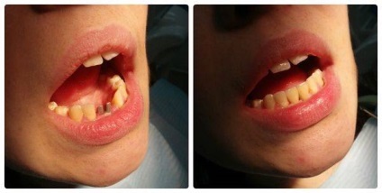 A fogászati implantátumok beteg beszámolók, olvasás, fotó, video (implantáció) A fogászati implantátumok beteg beszámolók, olvasás, fotó, videó