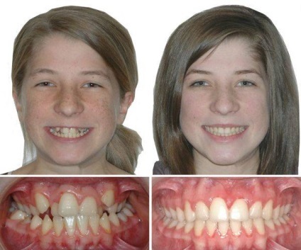 A fogászati ​​implantátumok beteg beszámolók, olvasás, fotó, videó