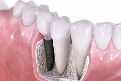 A fogászati implantátumok beteg beszámolók, bizonyság, fotók, videók (vélemény) A fogászati implantátumok beteg beszámolók, olvasás, fotó, videó