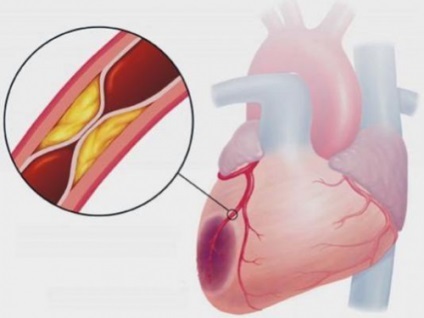 Miokardiális ischaemia, ez