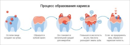 Hogyan lehet megállítani a fogszuvasodást - a kezelési módszerek és a megelőzés