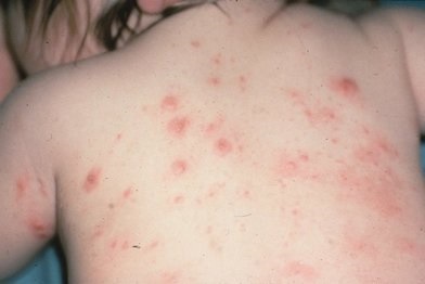 Hogyan lehet megkülönböztetni rubeola allergiák a gyermekek, allergia gyermekeknél (megkülönböztetni rubeola allergiák) Hogyan lehet megkülönböztetni rubeola allergiák a gyermekek, allergia gyermekeknél