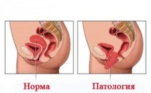 Як поставити внутрішні органи на місце, на шляху до довголіття