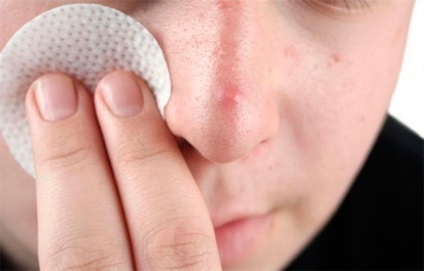 Hogyan lehet eltávolítani a mitesszerek orr