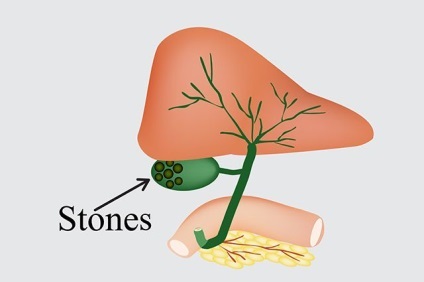 Hogyan lehet eltávolítani a köveket az epe-hólyag láb műtét nélkül