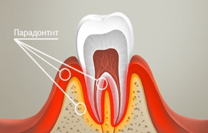 Osztályozása, típusú és mértékű parodontitis