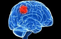 Cluster fejfájás - okok és a kezelés