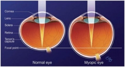 Javítás myopia a legjobb klinikák Moszkva, mintegy szembetegség