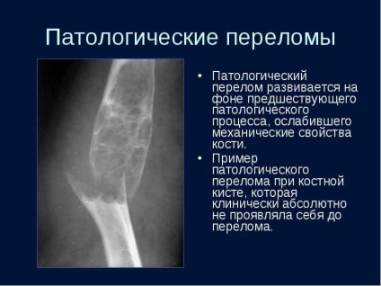 Csont ciszta okai, kezelése felnőttek és gyermekek esetében (kezelés) Csont ciszta okai, kezelése felnőttek és gyermekek