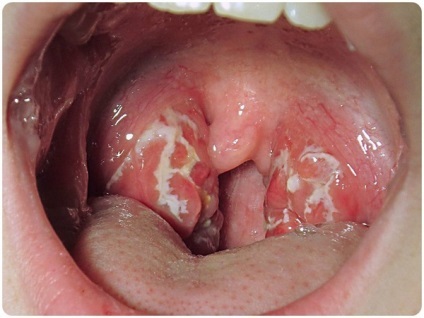 Hézagos mandulagyulladás gyermekeknél a betegség kezelésében és a fájdalom a torokban