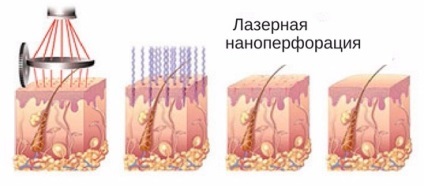 Laser nanoperforatsiya ez segít helyreállítani a vonzerejét az arc, bőr, striák, a szemhéjak, gondoskodás