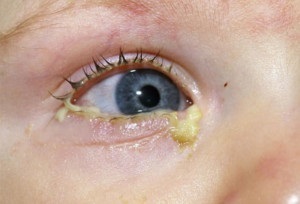 Kezelése gennyes kötőhártya a szem gyermekeknél és felnőtteknél (fotók)