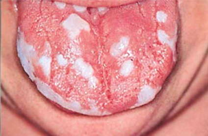 Pimafutsin kezelésére szájpenész a nők, férfiak és gyermekek engedje formák (kúpok, tabletták, tejszín)