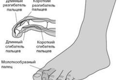 A kezelés deformáció Hammer lábujjak