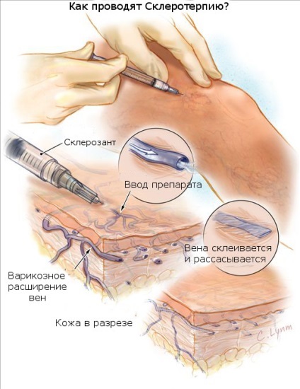 visszér kezelés klinikák Moszkva, árak, áttekintésre, kiválasztás phlebologist Online