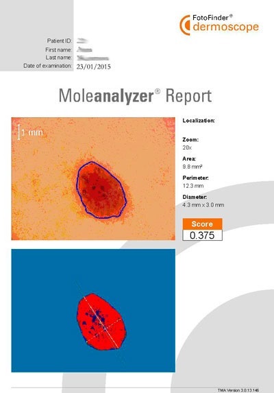 Melanoma mól ellenőrzött