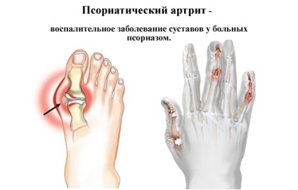 A metotrexát a rheumatoid arthritis kezelésében, és vélemények