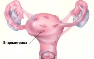 Kaphatok terhes endometriózis szakértői vélemény