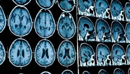 MRI kontraszt és anélkül különbség, főleg az eljárás