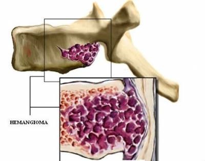 A gerinc hemangioma veszélyes (milyen méretű és típusú), szövődmények
