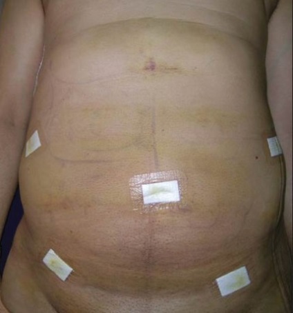 Szövődmények zsírleszívás után - a műtéti eltávolítása a zsír veszélyes