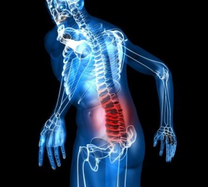 Osteochondrosis az ágyéki tünetek
