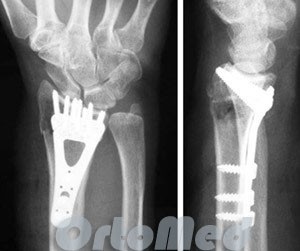Törött karú radiális csont egy tipikus helyen, egy ofszet nyaláb törés helyreállítási