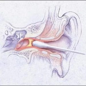 Valamilyen oknál fogva, viszketés a fülben belül a humán okai és vizsgálata, kezelése és megelőzése
