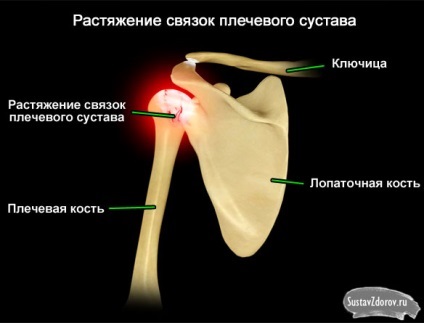 A nyújtás a vállízület szalagok okai, tünetei és kezelése