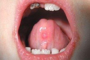 Bump a nyelv vagy alatta - sialocele fotó, pecsét kezelés