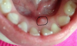 Bump a nyelv vagy alatta - sialocele fotó, pecsét kezelés