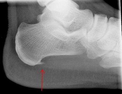 Calcaneus homlok - Causes, tünetek és kezelés (calcaneus tuber) Calcaneus homlok - okai, tünetei és kezelése