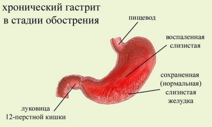Tünetei krónikus gastritis