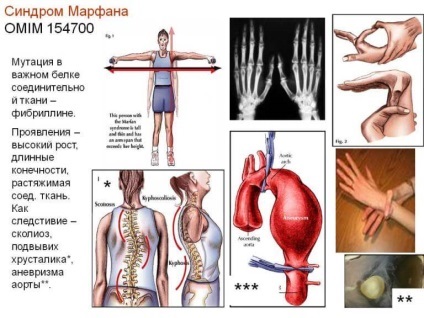 Marfan-szindróma jelei, tünetei, diagnózis és kezelés