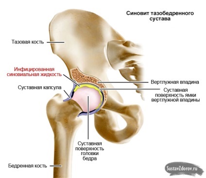 Synovitis lényege a betegség okai, tünetei, diagnózis és kezelés