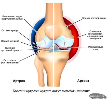 Synovitis lényege a betegség okai, tünetei, diagnózis és kezelés