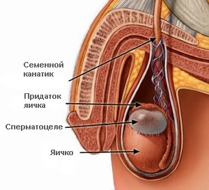 Spermatocele - okai, tünetei és kezelése