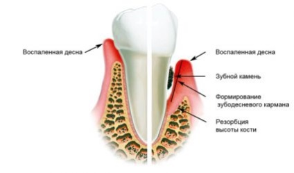 A mértéke a fogágy típusok jellemzőit és módját a kezelés