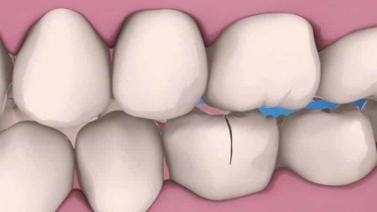 Repedt fog függőlegesen, mit kell tennie, ha repedt moláris vagy metszőfog
