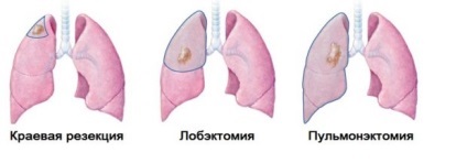 Eltávolítása tüdőrák hatások típusú műveletek