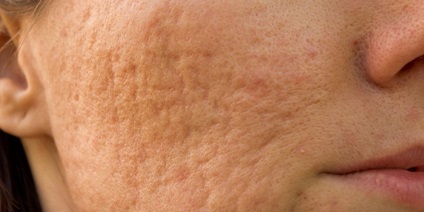 Sárga peeling alkalmazási javallatok és az eljárás lépéseit, az eredményekhez fűzött megjegyzéseket az ár (tulajdonságok) Sárga peeling alkalmazási javallatok és az eljárás lépéseit, az eredményekhez fűzött megjegyzéseket az ár