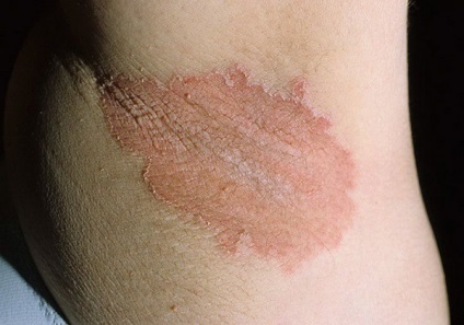 A leggyakoribb bőrbetegségek