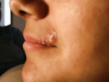Fehér pattanások ajkak (a bőr alá) okozza a