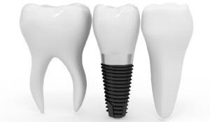 Melyek a fogászati ​​implantátumok