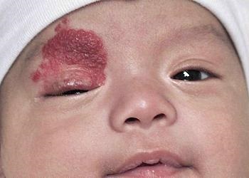 Hemangioma újszülöttek okai, következményei és kezelési módszerek